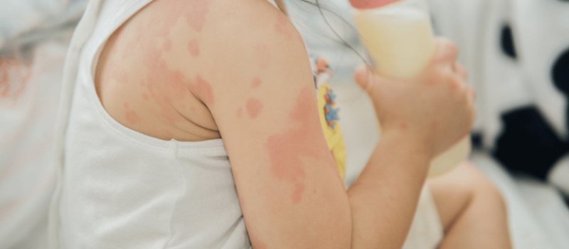 Vaikų alergija ir mityba. Vaiką išbėrė. Kaip atpažinti:  atopinis dermatitas ar alergija?  Kaip užkirsti kelią bėrimams?
