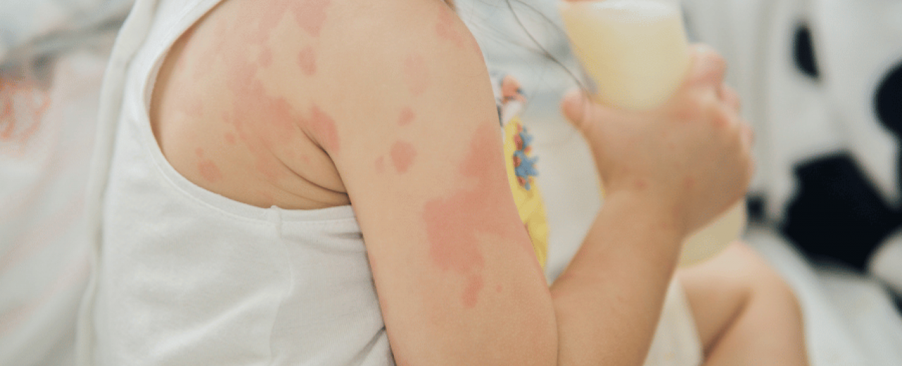 Vaikų alergija ir mityba. Vaiką išbėrė. Kaip atpažinti:  atopinis dermatitas ar alergija?  Kaip užkirsti kelią bėrimams?