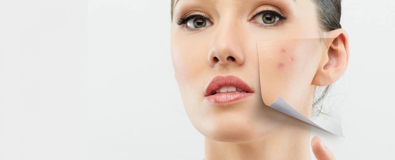 Svarbūs patarimai, kaip maitintis sergant akne 